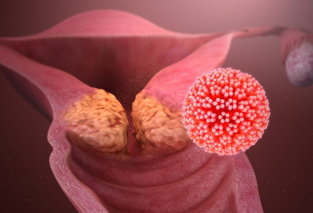 A IDENTIFICAÇÃO DO HPV NO EXAME PREVENTIVO.