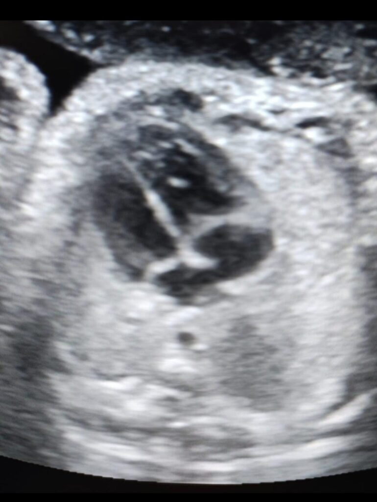 Ecocardiograma fetal.